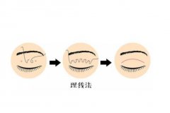 武汉天佑医院做双眼皮埋线多少钱