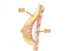 大连隆胸手术费用多少钱