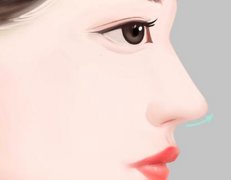 珠海假体隆鼻多少钱