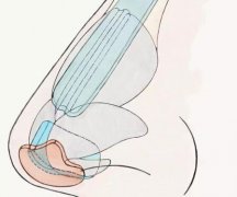 郑州鼻基底填充多少钱