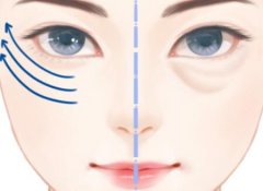 九院眼李圣利去眼袋多少钱