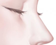 超肋骨鼻综合大概多少钱