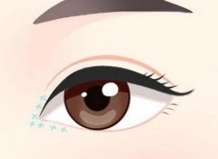 南宁韩志强开眼角多少钱