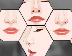 苏州假体隆鼻一般多少钱