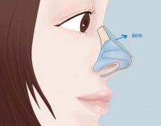 戴传昌医生做隆鼻多少钱