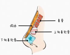 喜美王会勇隆鼻多少钱