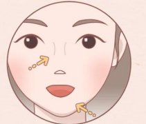 面部填充一般多少钱