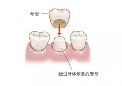 牙齿打桩做冠流程图片？牙齿打桩做冠可以维持多久