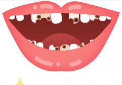牙齿上的黑点是什么？可能是细菌