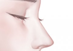 怎么缩小鼻翼和鼻头？通过脂肪抽脂，切除鼻翼组织等方式进行调节